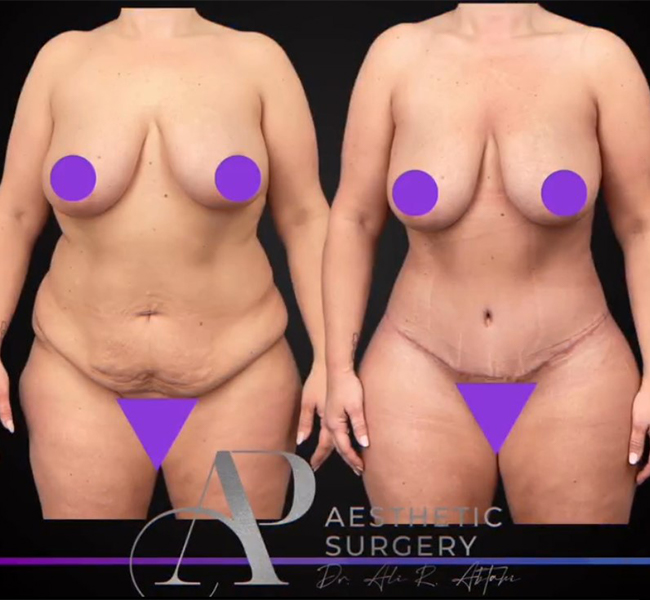 Abtahi-Tummy Tuck Before and After 1