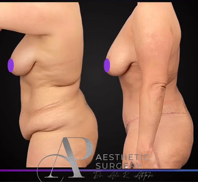Abtahi-Tummy Tuck Before and After 2b