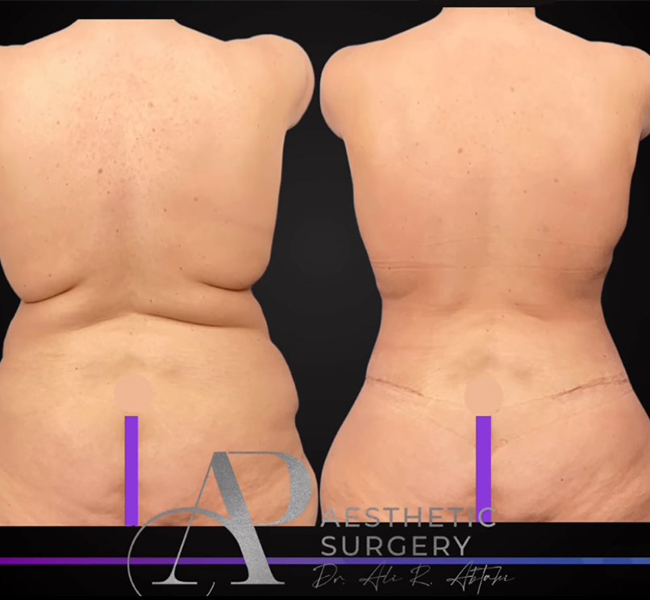 Abtahi-Tummy-Tuck-Before-and-After-3d