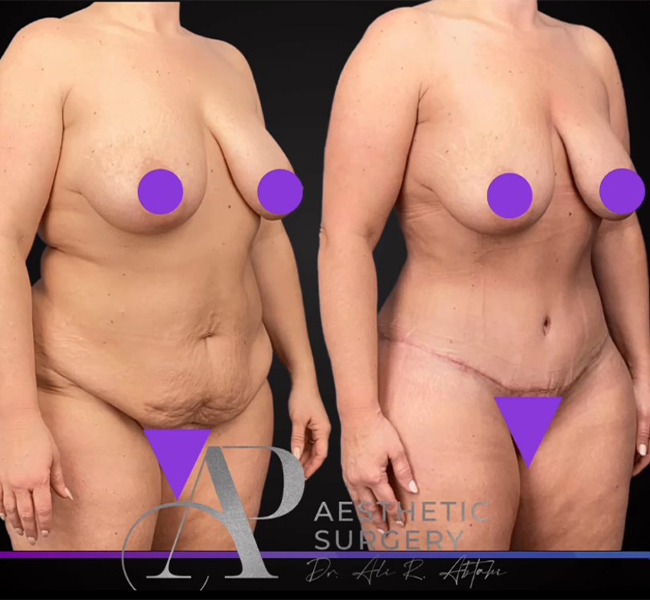 Abtahi-Tummy Tuck Before and After 4