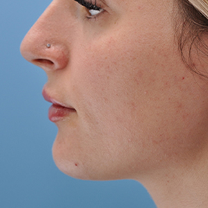 Abtahi-Dermal Fillers-Lip Augmentation-After1