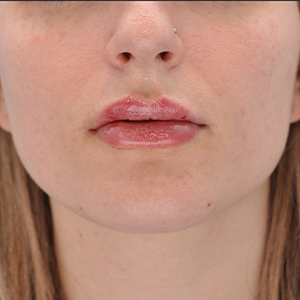 Abtahi-Dermal Fillers-Lip Augmentation-After2