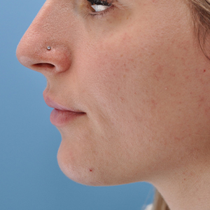 Abtahi-Dermal Fillers-Lip Augmentation-Before1