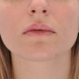 Abtahi-Dermal Fillers-Lip Augmentation-Before2