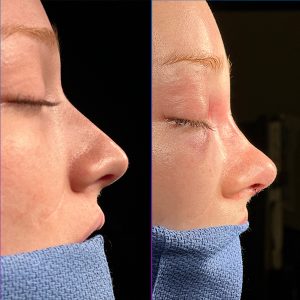 Abtahi-Rhinoplasty Results-2