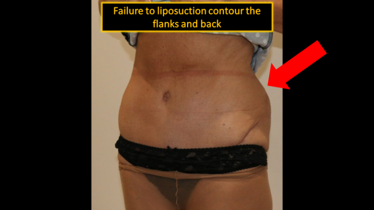 Tummy Tuck-Bad Result2