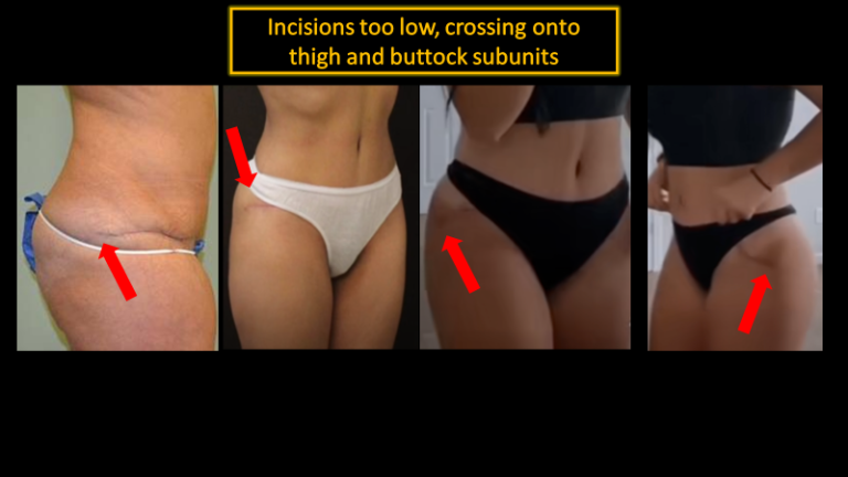 Tummy Tuck-Bad Result3