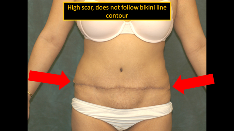 Tummy Tuck-Bad Result4
