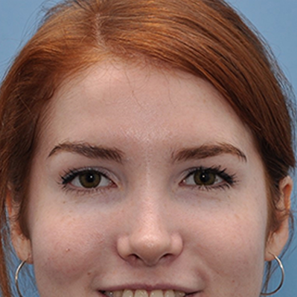 before Brow Lift & Eyelid Surgery female patient front view case 3317