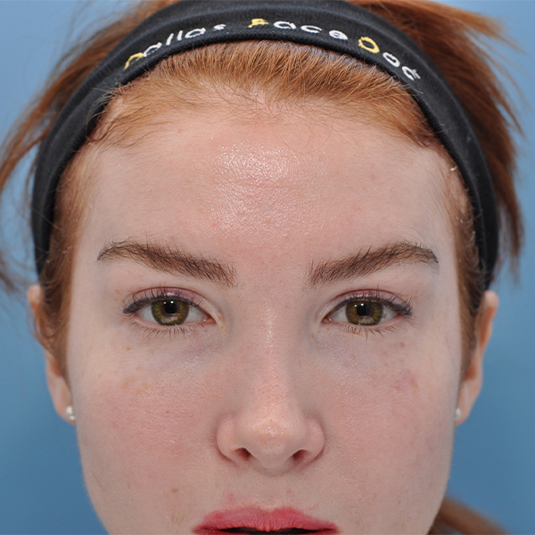 after Brow Lift & Eyelid Surgery female patient front view case 3317