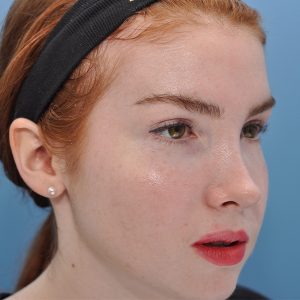 after Brow Lift & Eyelid Surgery female patient right angle view case 3317