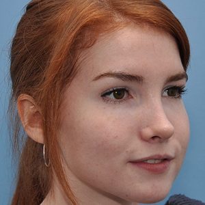 before Brow Lift & Eyelid Surgery female patient right angle view case 3317