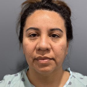 before deep plane facelift front view female patient case 3359