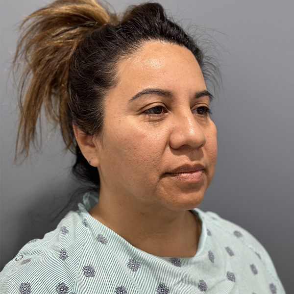 before deep plane facelift right angle view female patient case 3359