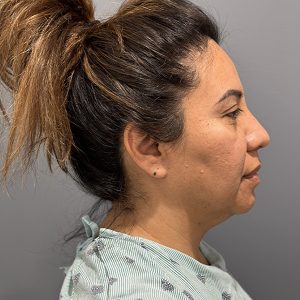 before deep plane facelift right side view female patient case 3359