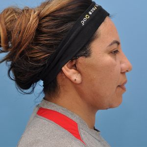 after deep plane facelift right side view female patient case 3359