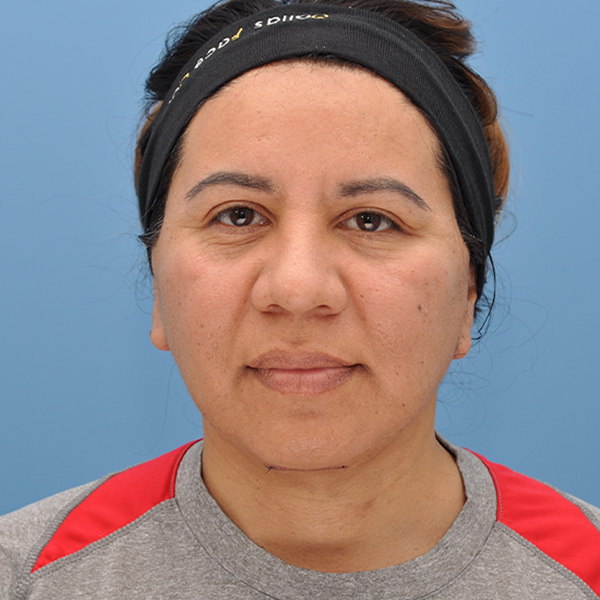 after deep plane facelift front view female patient case 3359