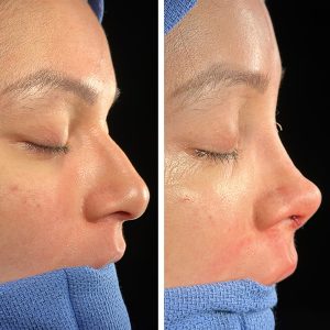 rhinoplasty--3293