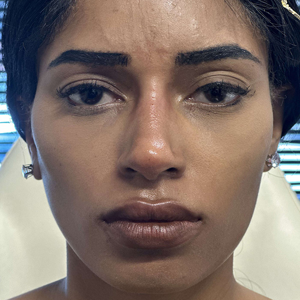 liquid-rhinoplasty--4163