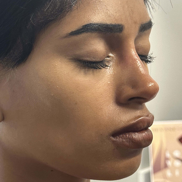 liquid-rhinoplasty--4164