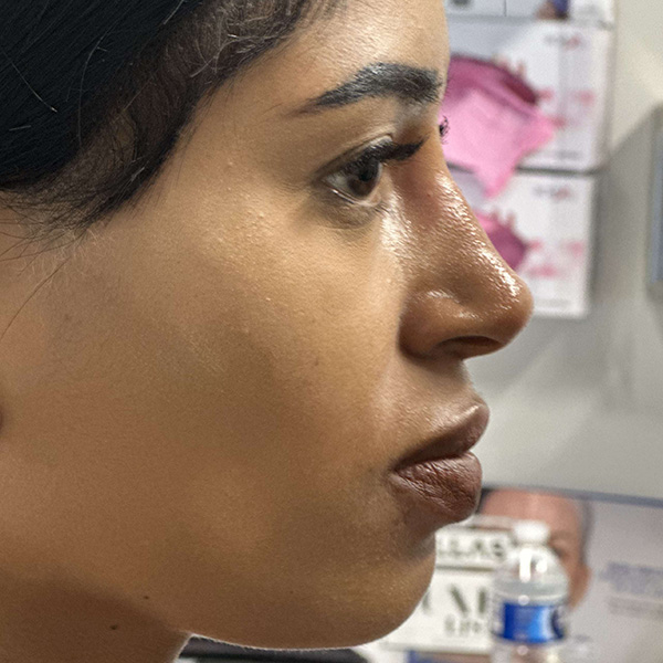 liquid-rhinoplasty--4165