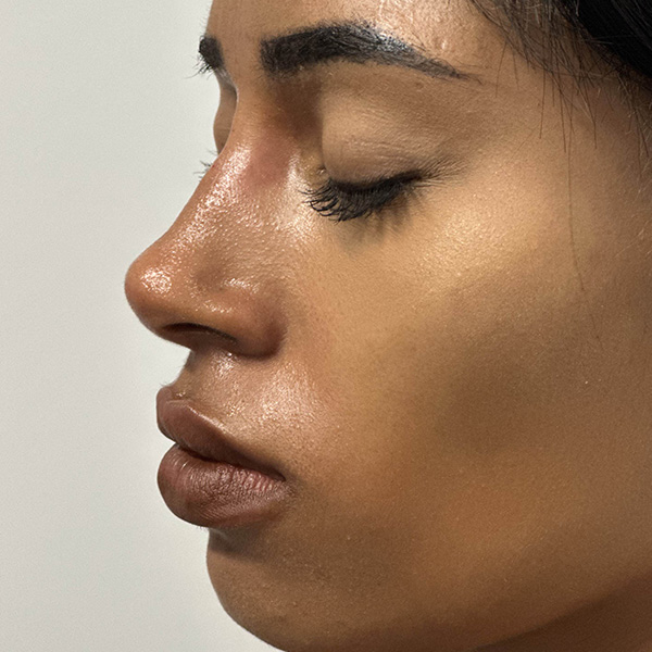 liquid-rhinoplasty--4166