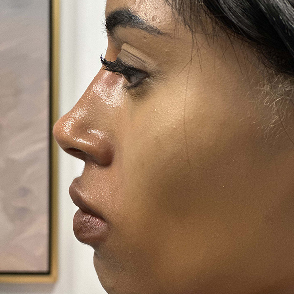 liquid-rhinoplasty--4167