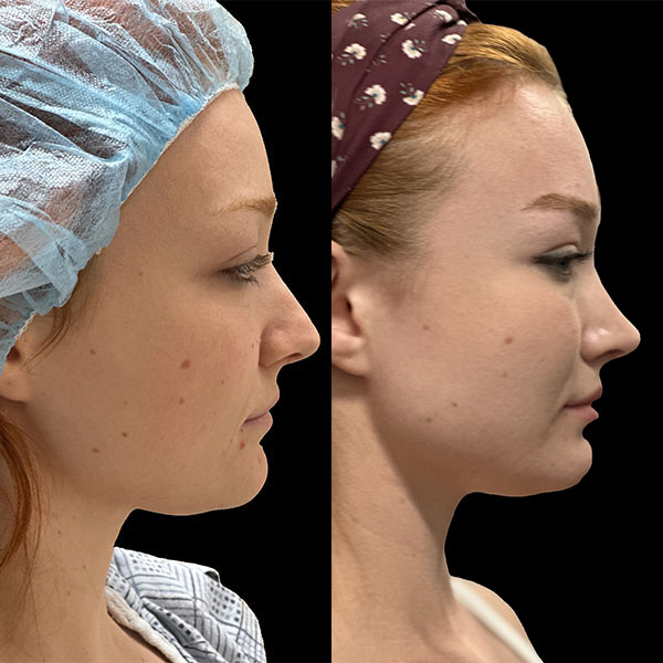 rhinoplasty--4632