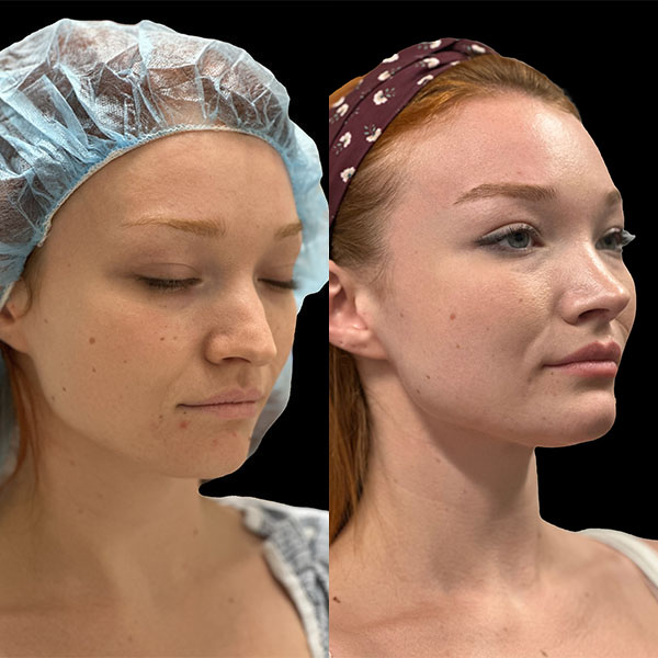 rhinoplasty--4633