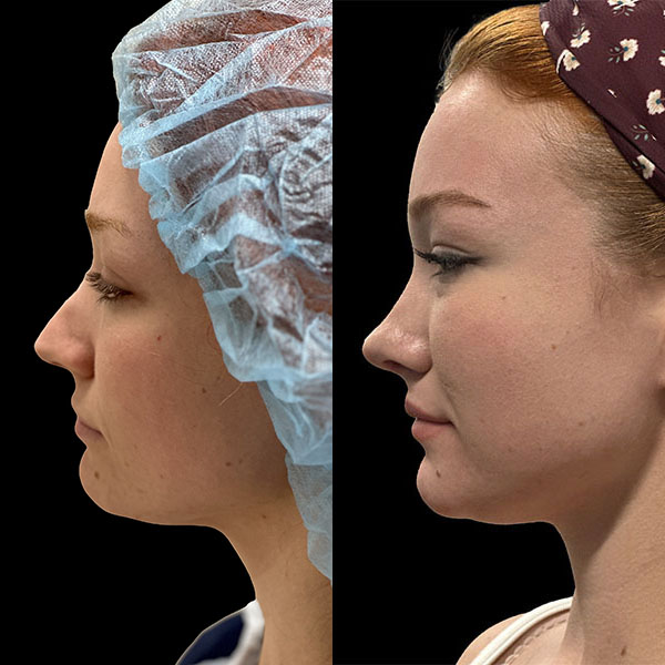 rhinoplasty--4634